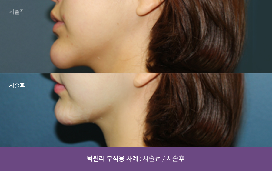 비절개 필러제거 전후사진