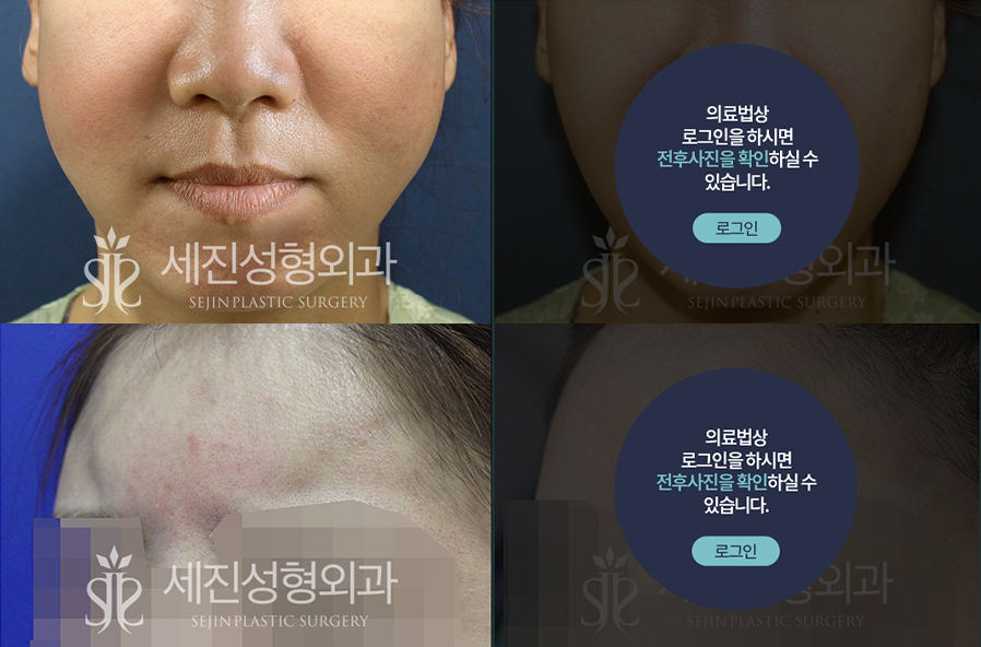 비절개 지방이식 치료 전후사진